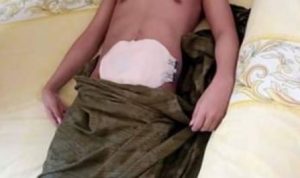 Butuh Uluran Tangan, "TOMI" Seorang Pelajar warga Desa Lambai menderita Usus Buntu Menahun